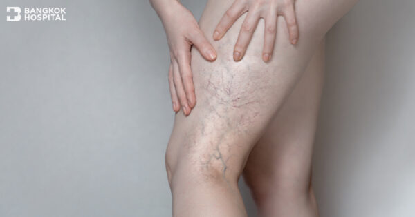 Seven interesting facts about varicose veins. Never leave them untreated!