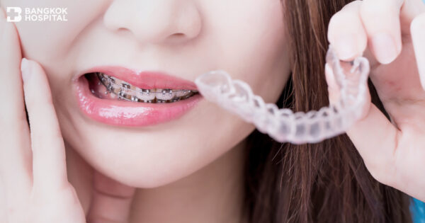 Invisalign Debonding® as a substitute to traditional braces