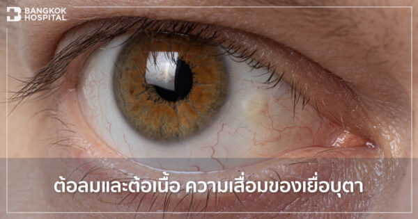 ต้อลมและต้อเนื้อ ความเสื่อมของเยื่อบุตา | Bangkok Hospital ต้อลมและต้อเนื้อ ความเสื่อมของเยื่อบุตา | Bangkok Hospital