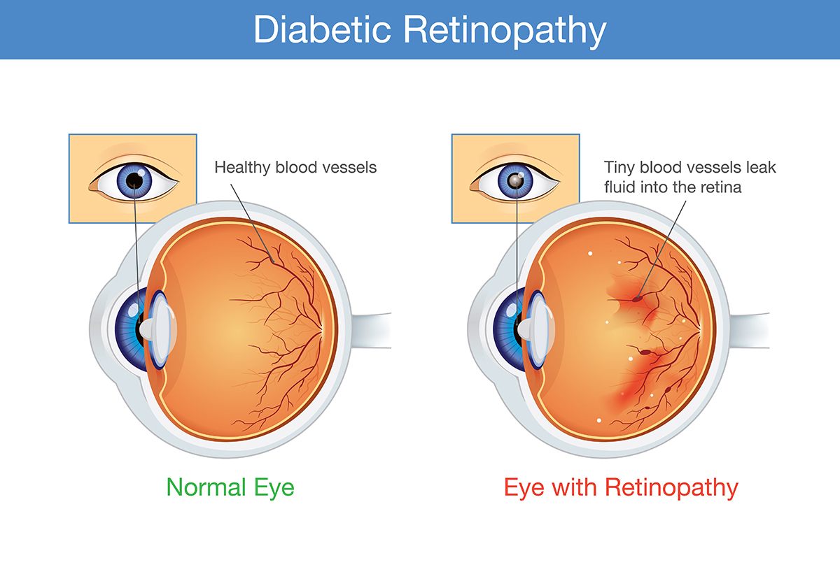 ជំងឺទឹកនោមផ្អែម Retinopathy ថែរក្សាវាឱ្យបានល្អមុនពេលអ្នកបាត់បង់ចក្ខុវិស័យរបស់អ្នក។