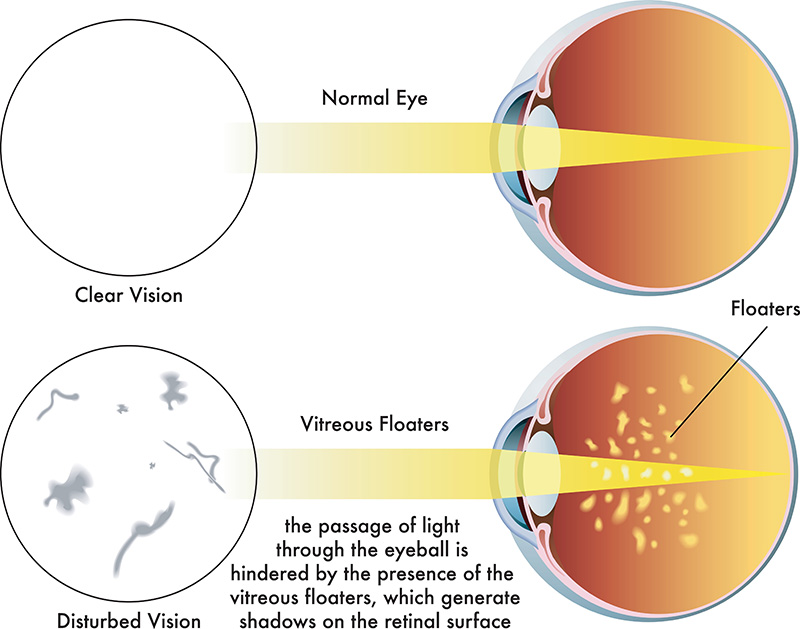 vitreous humor floaters