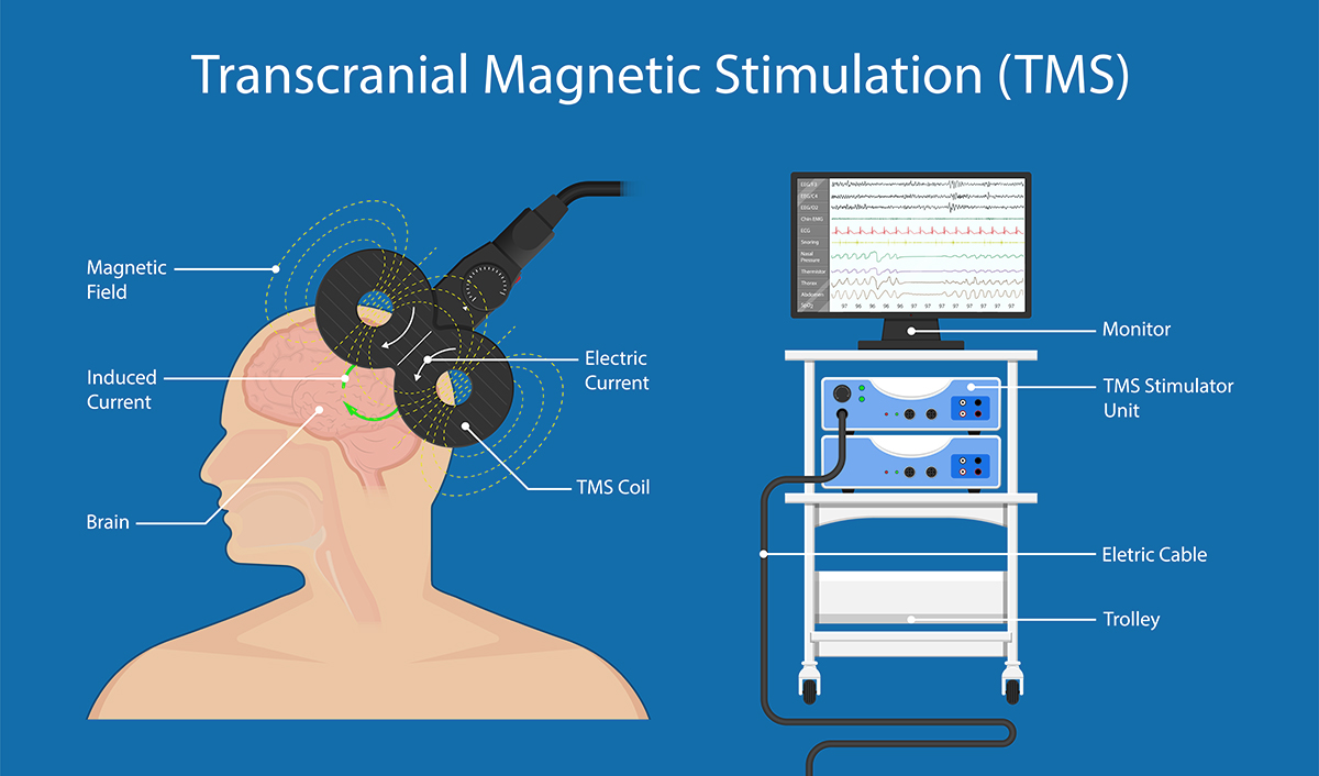 TMS で治療抵抗性うつ病の患者のケア