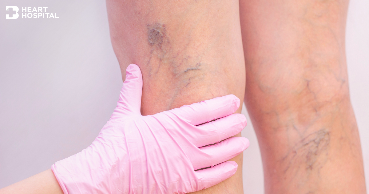 Varicose Veins Bangkok Heart Hospital